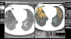 Обучающее видео. Программа "Эмфизема легких"