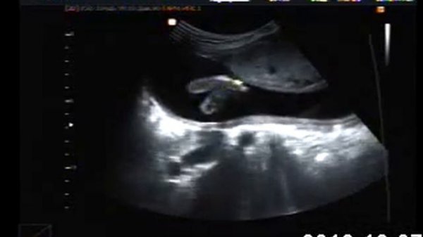 Моя доча 23 недели УЗИ.