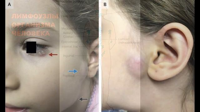 Болезнь Кошачьих Царапин (Фелиноз) смотреть онлайн