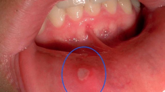 Milk Kasalliklari Va Uni Davolash (стоматит)