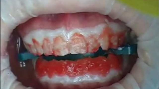 Отбеливание зубов