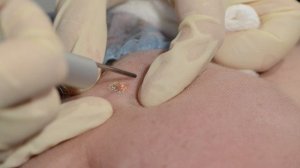 Удаление кератомы на лице лазерным методом