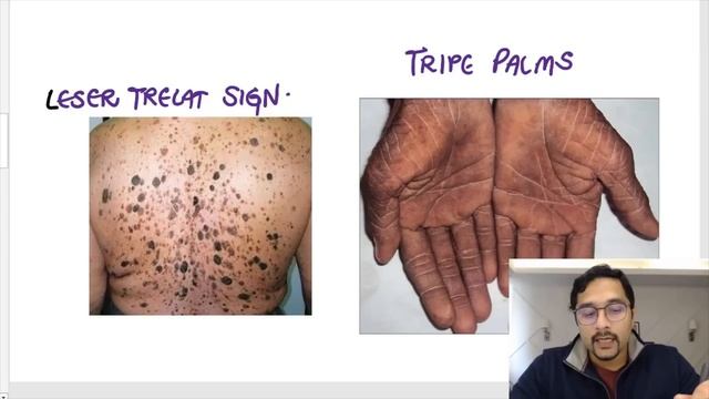 FMGE Important Questions | GIT & Hepatobiliary System | Dr. Rohan Khandelwal | FMGE Exam 2023 смотреть онлайн