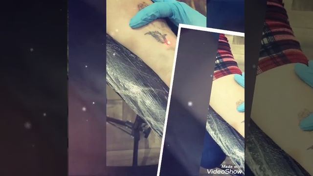 Удаление татуировки лазером - Пятигорск смотреть онлайн