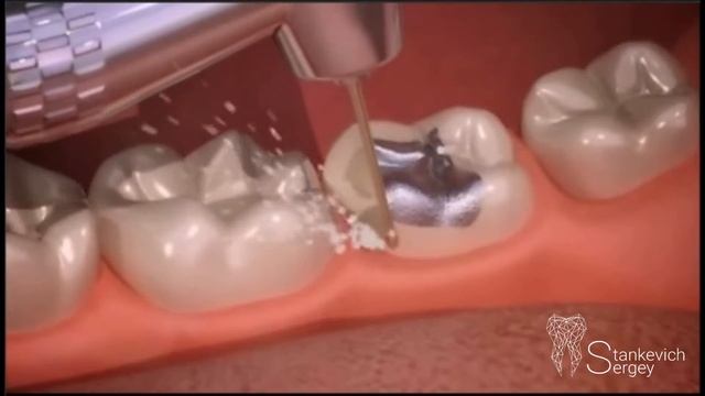 Ceramic Inlays Onlay