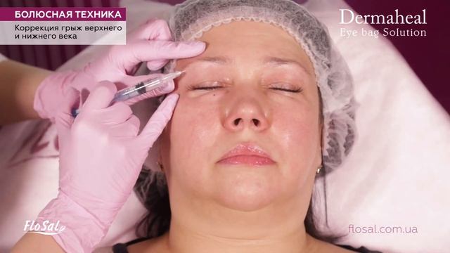Коррекция грыжевых мешков верхнего и нижнего века препаратом Dermaheal Eyebag Solution