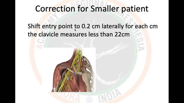 PNS GUIDED INFRA-CLAVICULAR BLOCK смотреть онлайн