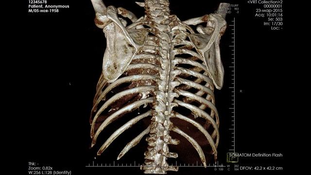 Опухоль грудины. Хондросаркома? Остеосаркома? смотреть онлайн