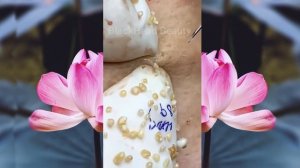 Выдавливание чёрных точек НОВОЕ! Удаление чёрных точек за ухом. p13