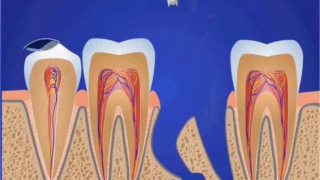 Удаление зуба средней сложности с разделением на части. Остеопластика