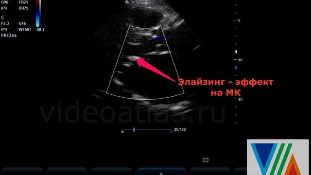 Стеноз АК и МК (расчётная площадь открытия клапанов) смотреть онлайн