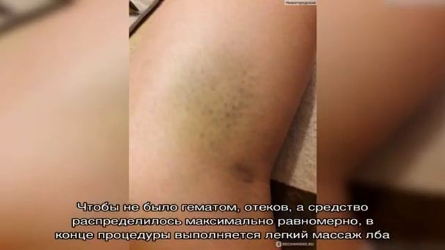 Инъекции «Ботокса» в лоб – эффективный метод борьбы с морщинами смотреть онлайн
