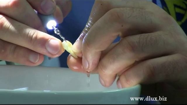 Препарирование скалером UDS-L LED,насадкой E9 Woodpecker.2 часть смотреть онлайн