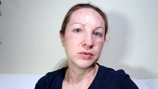 Биоревитализация лица гиалуроновой кислотой. смотреть онлайн