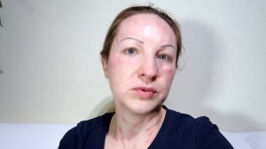 Биоревитализация лица гиалуроновой кислотой.