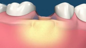 Разрушение зуба, Можно ли восстановить сильно разрушенные зубы