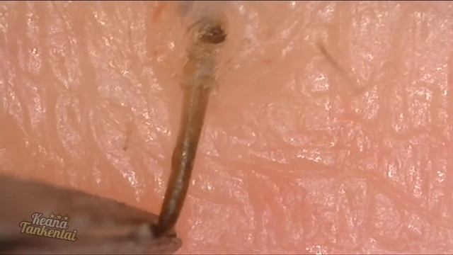 Ingrown Hair Removal Close Up 200X | 埋没毛を除去