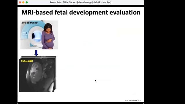 Prof. Leo Joskowicz: Accelerating Deep Learning Segmentation And Modeling From Medical Images смотреть онлайн