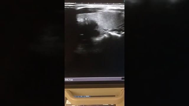 УЗИ щитовидной железы смотреть онлайн