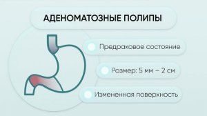 Полипы желудка: причины, диагностика и лечение