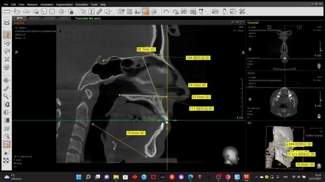 Как сделать реконструкцию ТРГ и ОПТГ из КТ смотреть онлайн
