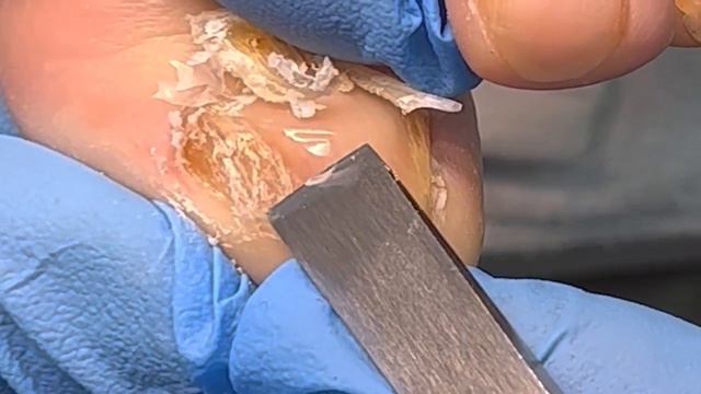 Yellowing nails Doctors cut thick cuticles with knife【Xue Yidao Pedicure】 смотреть онлайн