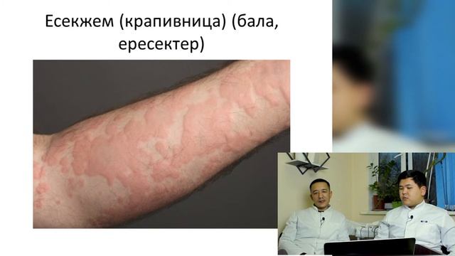 Тері аурулары: Атопиялық дерматит, Крапивница, Псориаз... |#ШИПАГЕР смотреть онлайн