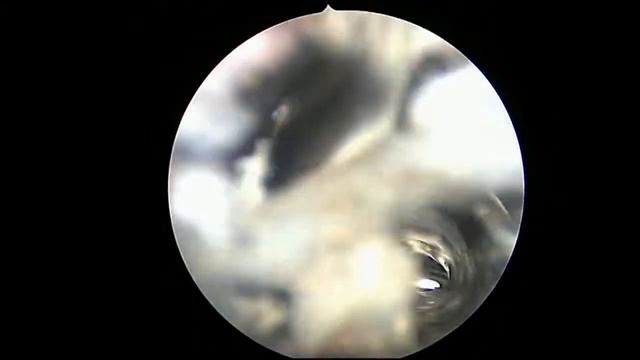 TURV piccolo papilloma смотреть онлайн