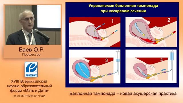 Управляемая баллонная тампонада. Новая акушерская тактика. Послеродовые кровотечения смотреть онлайн