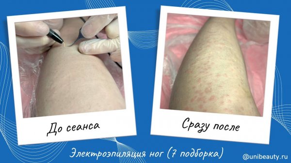 Электроэпиляция ног методом blend