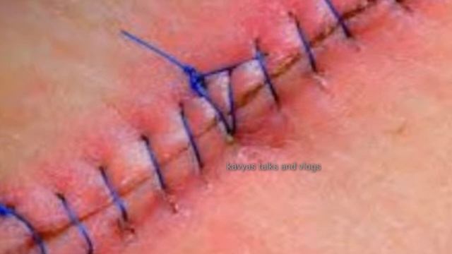 c section stitches types/zip sutures uses/pregnancy care/c section methods смотреть онлайн