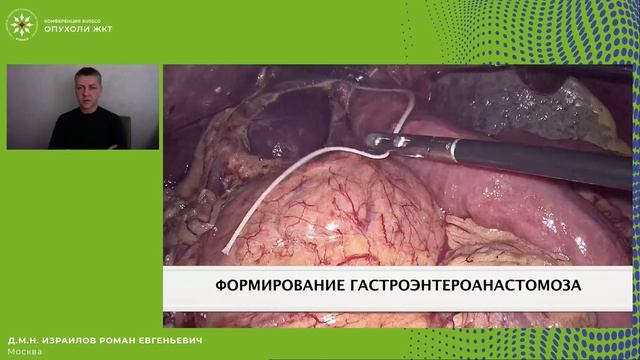 Лапароскопическая проксимальная резекция желудка