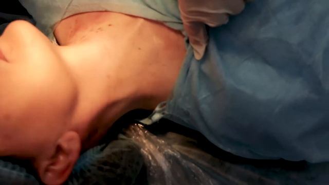 Удаление множественных папиллом смотреть онлайн