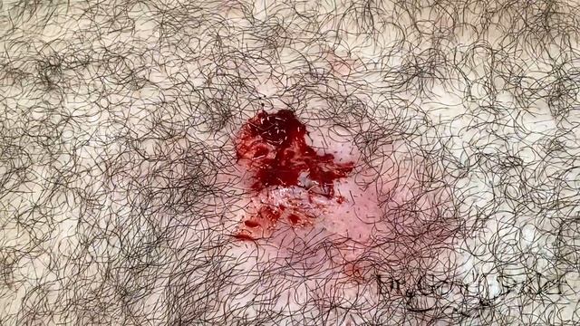 Removal of infected cyst from chest смотреть онлайн