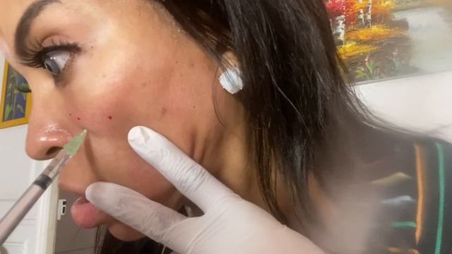 POUR UNE BELLE PEAU la mésothérapie avec acide hyaluronique et vitamines смотреть онлайн