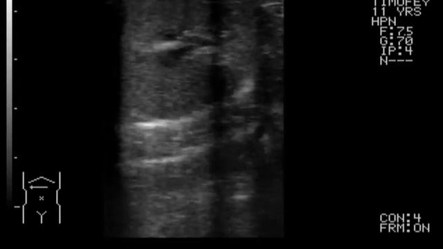 2011.10.12 - к. Тимофей ХПН 11 лет.avi смотреть онлайн