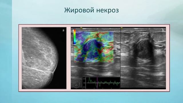 Ультразвуковая диагностика и особенности малоинвазивных методов лечения лактационных маститов смотреть онлайн