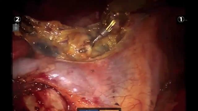 Asvide: Radical lymph node dissection of station R2–R4 смотреть онлайн