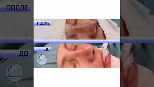 Вторичная ринопластика видео2 смотреть онлайн