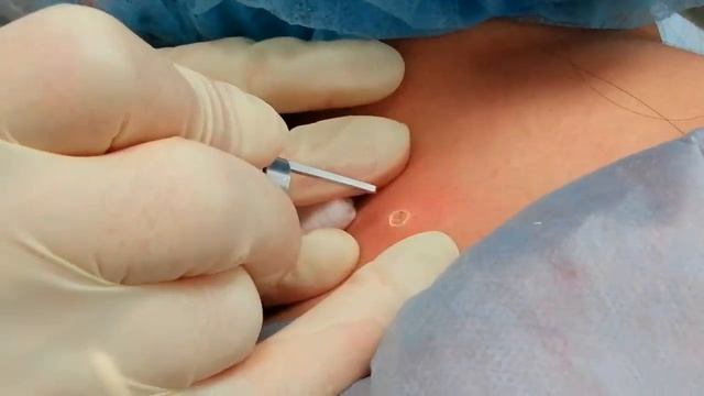 Удаление родинок лазером смотреть онлайн