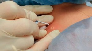 Удаление родинок лазером