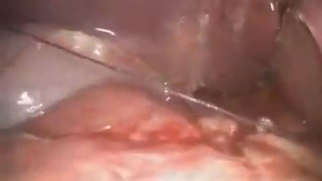 Лапароскопическое ушивание язвы 12 п.к. Оперативное лечение перфоративной язвы желудка и 12 п.к. смотреть онлайн