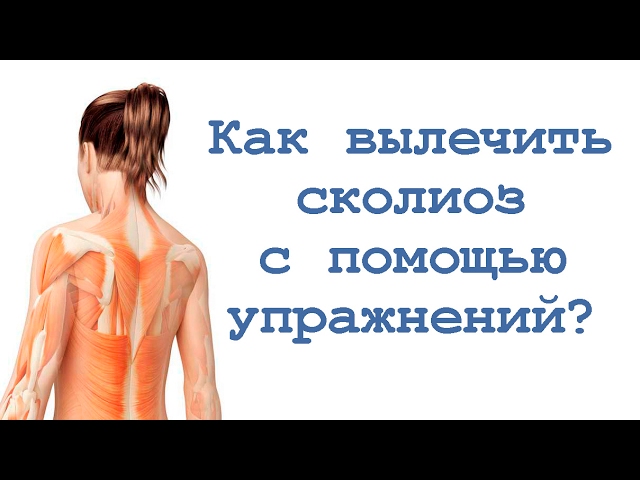 Как вылечить сколиоз с помощью упражнений? смотреть онлайн