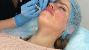 Заполнение кисетных морщин филлером Belotero Soft и увеличение губ