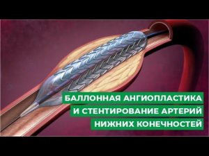 Баллонная ангиопластика и стентирование артерий нижних конечностей