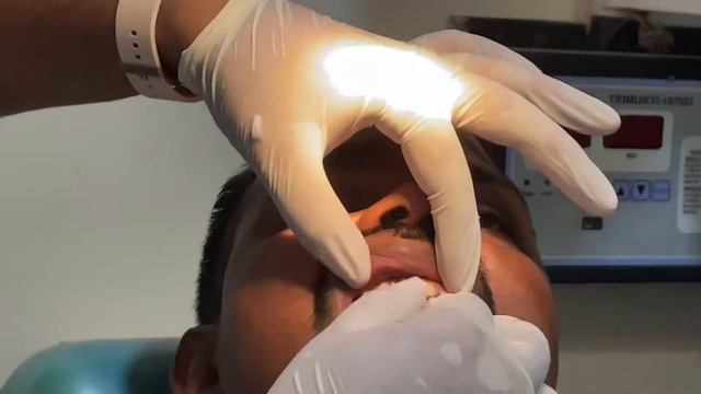 Ellis class-3 & Root Canal Treatment -11 Full Procedure смотреть онлайн