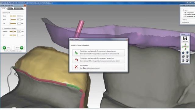 EXOCAD TUTORIAL - CAD/CAM-Teaser - Korrektur des Antagonisten смотреть онлайн