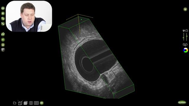 Полиповидное ворсинчатое образование среднеампулярного отдела прямой кишки UT1SM3N0 смотреть онлайн