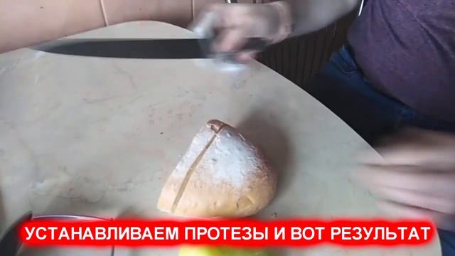 Протез пальца. Презентация. смотреть онлайн