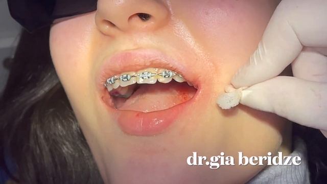 #удаление зуба мудрости в батуми смотреть онлайн